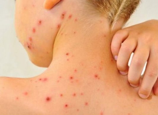 Қызылша: Жетісудағы эпидемиологиялық жағдай тұрақты