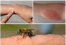 Экстренная помощь при укусах насекомых