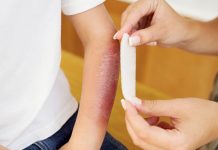 Экстренная помощь при ожогах