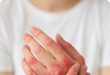 Осторожно, дерматомикоз!