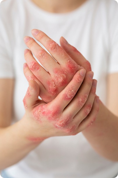 дерматофия