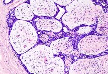 Фиброаденома