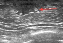 Гинекомастия у мужчин