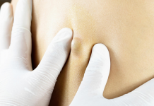 Липома молочной железы